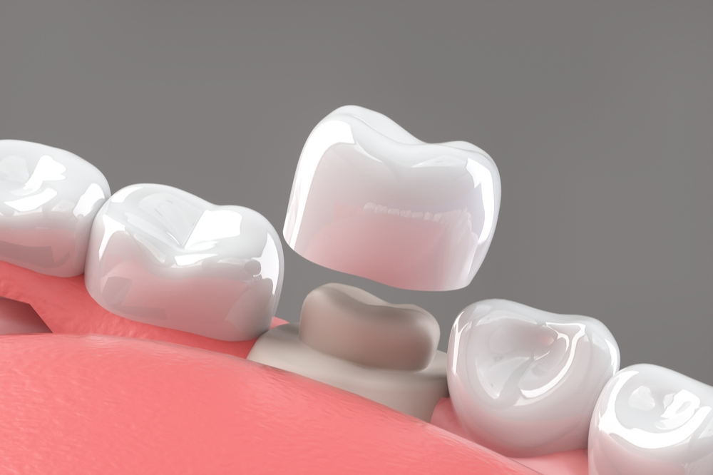 A Guide To Preserving Dental Crowns And Preventing Problems