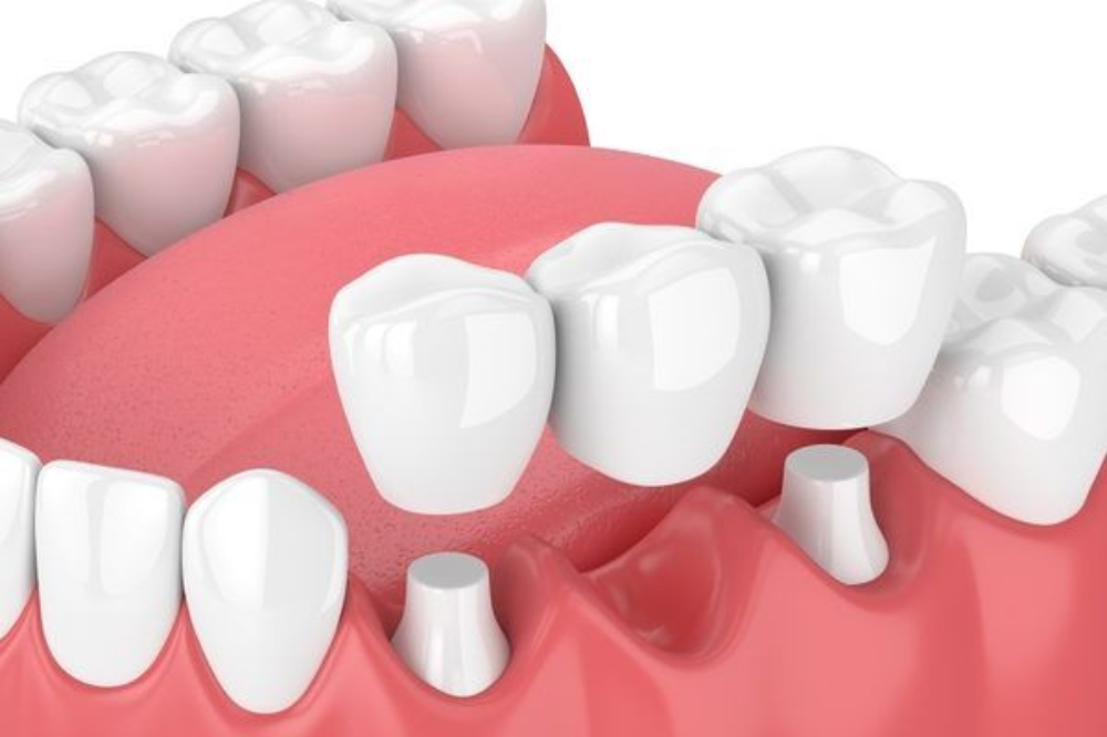 Exploring Various Varieties of Dental Bridges
