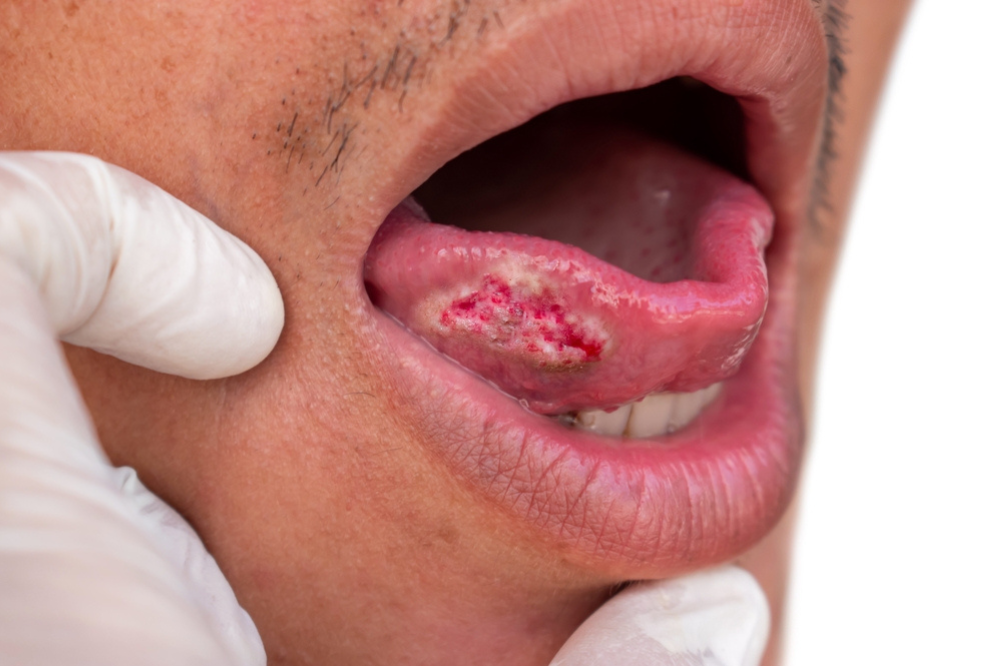 Oral Cancer Signs and Self-Screening