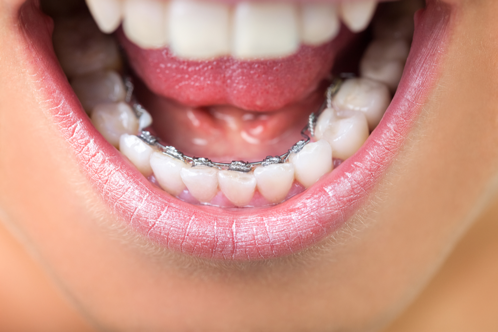Things You Should Know About Lingual Braces