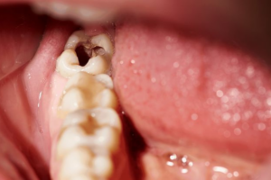 Are there any Long-term Effects of Leaving a Cavity Untreated?