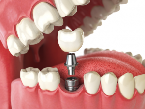 What To Expect From Dental Implants Process