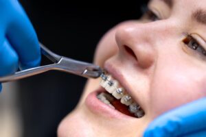 a young lady putting orthodontics on her teeth