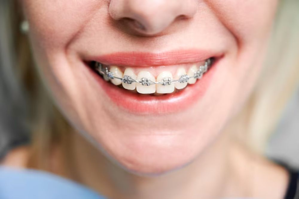 a lady is smiling after putting braces