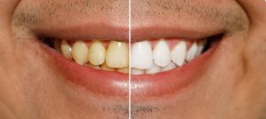 can yellow teeth become white again