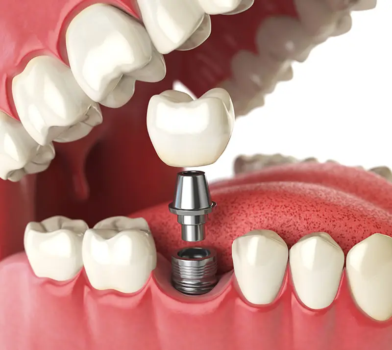 dental-implants-near-you